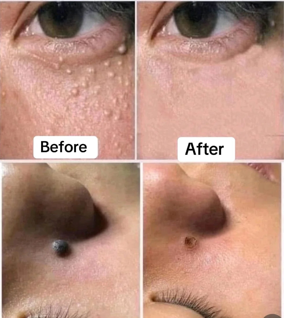 🌿 Removedor de Verrugas Solución Natural y Eficaz para una Piel Libre de Imperfecciones